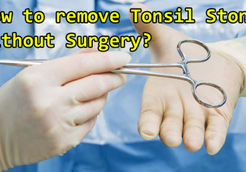 tonsil stones